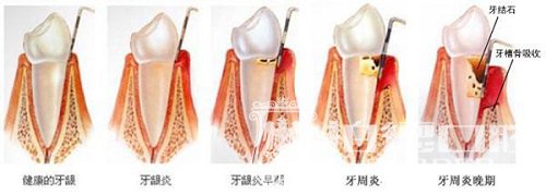 牙周炎