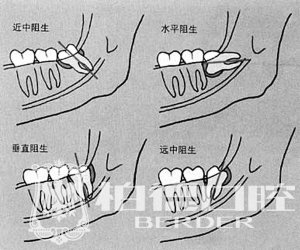 智齿发威该怎么办？