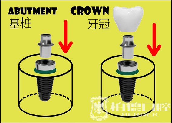 种植牙手术需要多长时间？