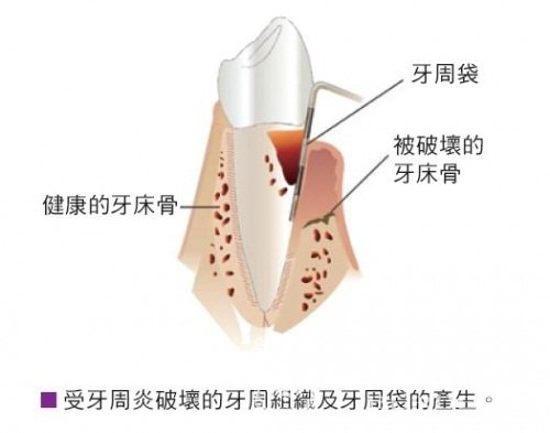 离牙周病越近，离健康越远！