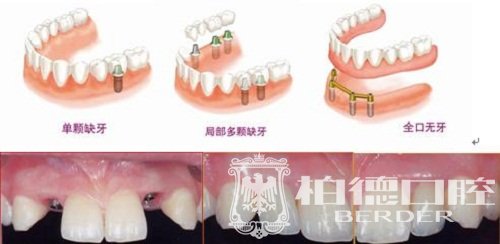 昆明柏德口腔，德国牙医快速舒适种好牙