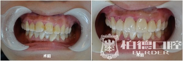 柏德口腔3D超薄全瓷牙贴面