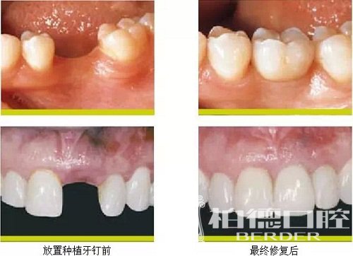 三个理由告诉你，老年人到底有没必要种牙？