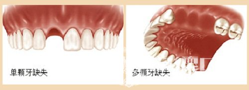 五月聚“惠”柏德口腔，体验德国种植牙