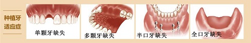 种植牙和假牙义齿有什么区别？