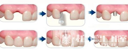 种植牙如何收费