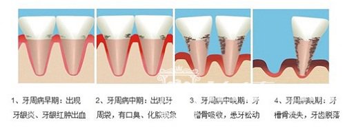 牙周病来袭，也能任性吃一夏