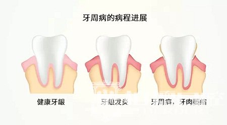 洗牙，是一种生活态度